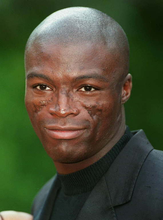 Seal Speaks About the Scars on His Face: A Journey of Resilience and Self-Acceptance
