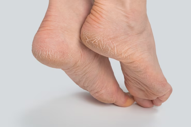 Effective Treatment For Cracked Heels in Winter